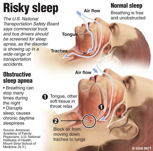 can zetia cause fatigue