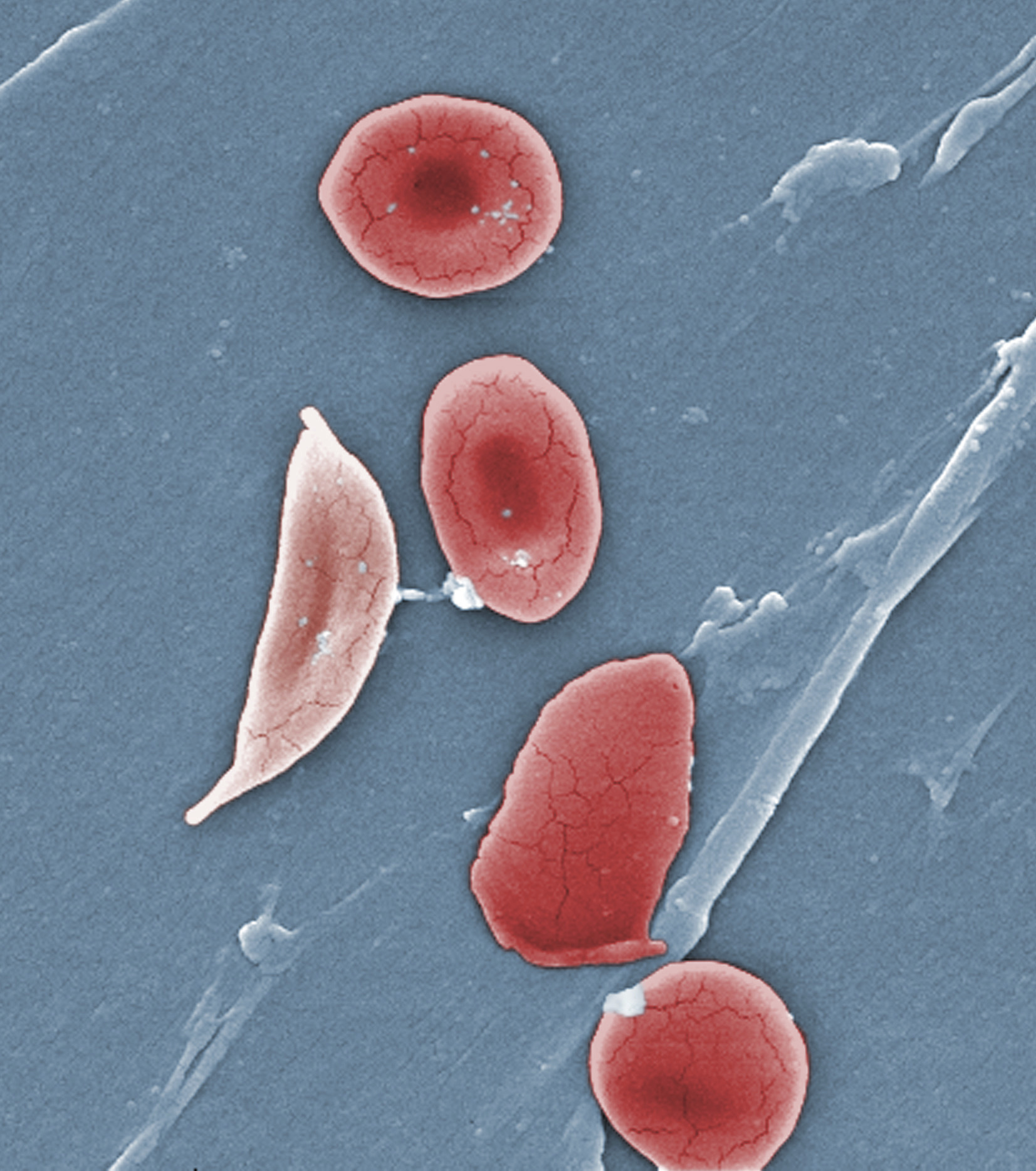 gene-therapy-targets-sickle-cell-disease-scientific-american